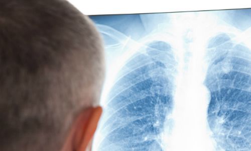 Léčba plicních onemocnění s pomocí nanočástic a genetických modifikací